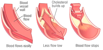 Lowering cholesterol - Risks and benefits of Statins