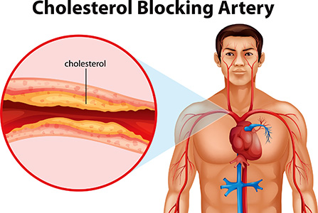 Lowering cholesterol - Statins