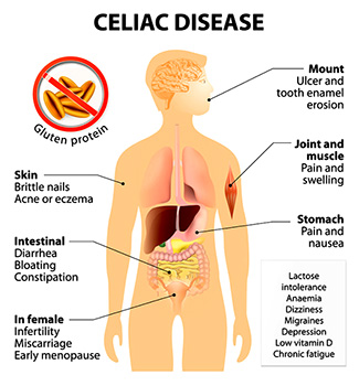 what is gluten celiac disease symptom